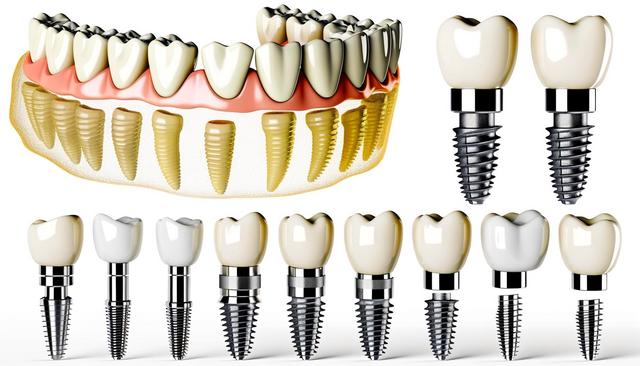 Illustration of dental implants showing gum layer, implant roots in jawbone, and various crown types.